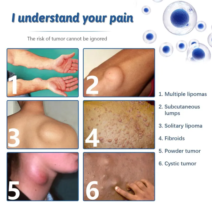 Lipomas%20Removal%20Spray%20Relief%20Pain%20Treat%20Skin%20Swelling%2050ml%20Nodule%20Removal%20Cellulite%20Spray%20Lipolysis%20Ointment%20Fat%20Lump%20U6M8%20-%20Image%204