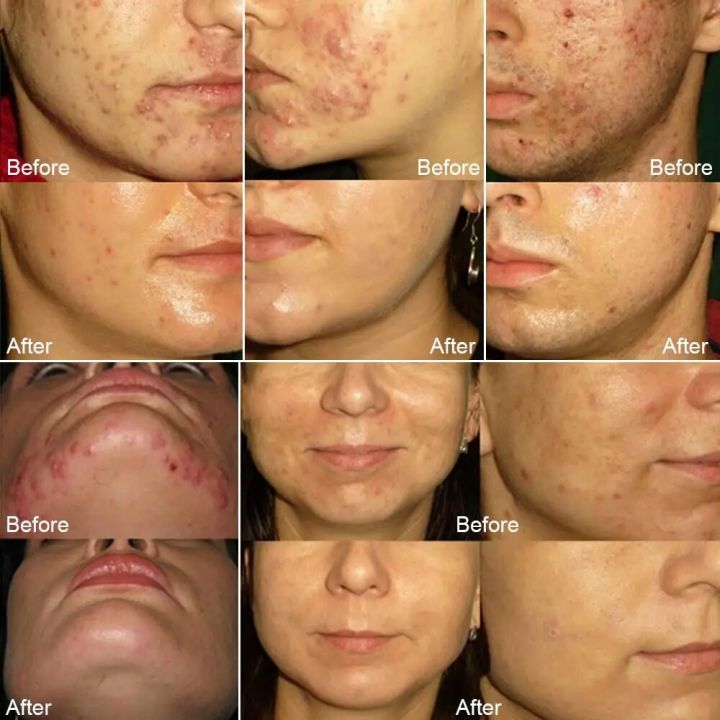 Sea%20Salt%20Soap%20Exfoliating%20Acne%20Treatment%20Deeply%20Goat's%20Milk%20Soap%20Body%20Whitening%20Cleaner%20Pores%20Blackheads%20Removal%20Makeup%20Tools%20-%20Image%204