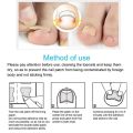 Pexmen 10/20/50/100Pcs Ingrown Toenail Correction Stickers Toenail Corrector Patch Keep Nails Healthy Relieve Pain.