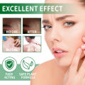 Hair Follicle Cream Treat Scalp Hair Folliculitis Skin Inflammation Cysts Papules Spot Remover Body Acne Anti Itching Ointment. 