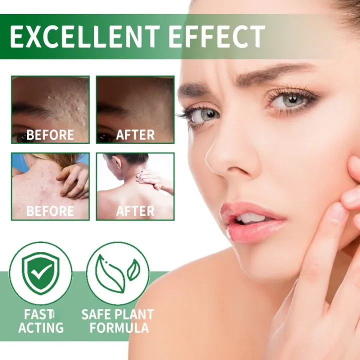 Hair%20Follicle%20Cream%20Treat%20Scalp%20Hair%20Folliculitis%20Skin%20Inflammation%20Cysts%20Papules%20Spot%20Remover%20Body%20Acne%20Anti%20Itching%20Ointment%20-%20Image%204