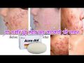 Acne Aid Soap Bar100gm. 