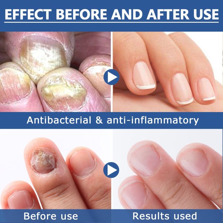 Fungus%20Nail%20Serum%20Repair%20Toenail%20Fungal%20Treatment%20Essence%20Anti%20Infection%20Drops%20Paronychia%20Remove%20Cuticle%20Oil%20Feet%20Nail%20Care%2030ml%20-%20Image%206