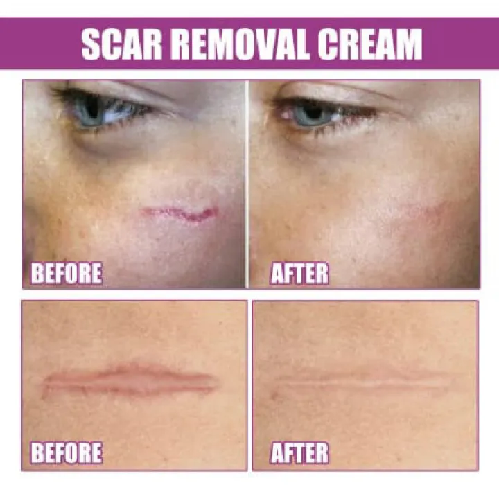 Scar%20Removal%20Cream%20Repairing%20Damaged%20Skin%20Reducing%20Scars%20And%20Smoothing%20The%20Skin%2050g,%20%E0%A6%95%E0%A6%BE%E0%A6%9F%E0%A6%BE%20%E0%A6%93%20%E0%A6%AA%E0%A7%81%E0%A7%9C%E0%A7%87%20%E0%A6%AF%E0%A6%BE%E0%A6%93%E0%A7%9F%E0%A6%BE%E0%A6%B0%20%E0%A6%A6%E0%A6%BE%E0%A6%97%20%E0%A6%B8%E0%A7%8D%E0%A6%95%E0%A6%BF%E0%A6%A8%20%E0%A6%A5%E0%A7%87%E0%A6%95%E0%A7%87%20%E0%A6%AE%E0%A7%81%E0%A6%9B%E0%A7%87%20%E0%A6%AB%E0%A7%87%E0%A6%B2%E0%A7%81%E0%A6%A8%E0%A5%A4%20%E0%A6%AE%E0%A7%81%E0%A6%96%E0%A6%AE%E0%A6%A8%E0%A7%8D%E0%A6%A1%E0%A6%B2,%20%E0%A6%B9%E0%A6%BE%E0%A6%A4,%20%E0%A6%AA%E0%A6%BE,%20%E0%A6%AC%E0%A6%A1%E0%A6%BF%20%E0%A6%85%E0%A6%A5%E0%A6%AC%E0%A6%BE%20%E0%A6%B8%E0%A7%8D%E0%A6%95%E0%A6%BF%E0%A6%A8%E0%A7%87%E0%A6%B0%20%E0%A6%AF%E0%A7%87%E0%A6%95%E0%A7%8B%E0%A6%A8%E0%A7%8B%20%E0%A6%AF%E0%A6%BE%E0%A7%9F%E0%A6%97%E0%A6%BE%E0%A6%A4%E0%A7%87%20%E0%A6%AC%E0%A7%8D%E0%A6%AF%E0%A6%AC%E0%A6%B9%E0%A6%BE%E0%A6%B0%20%E0%A6%95%E0%A6%B0%E0%A6%A4%E0%A7%87%20%E0%A6%AA%E0%A6%BE%E0%A6%B0%E0%A6%AC%E0%A7%87%E0%A6%A8,%20#lazbinstore%20-%20Image%204