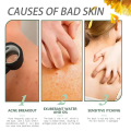 White Cream, Moisturizing Skin, Chicken Repair Cream, Buttocks, Back Acne, Body Acne Cream, Facial Sores, Smooth Marks.