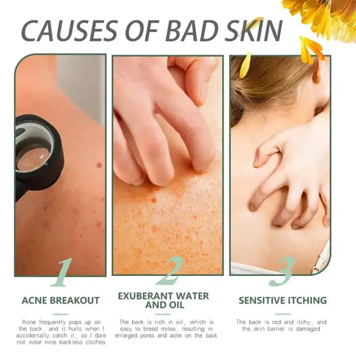 White%20Cream,%20Moisturizing%20Skin,%20Chicken%20Repair%20Cream,%20Buttocks,%20Back%20Acne,%20Body%20Acne%20Cream,%20Facial%20Sores,%20Smooth%20Marks%20-%20Image%203