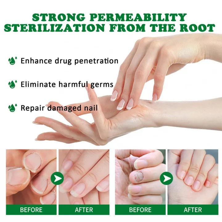 EELHOE%20Makes%20Your%20Nail%20Clean%20EELHOE%20Nail%20Repair%20Serum%20Nail%20Repair%20Oil%2015ML%20-%20Image%204