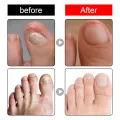 South Moon Inner Toenail Repair Serum, Nail Repair Nail Care, Nail Care, Essential Oils, Cleanse and Remove Nail Fungus. 