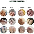 7 Day Nail Fungus Removal Cream Treatment Fungal Toe Nail Repair Gel Anti-infection Paronychia Onychomycosis Foot Care Product For Men/Women. 