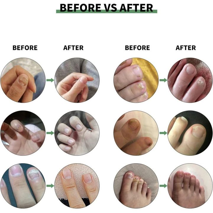 7%20Day%20Nail%20Fungus%20Removal%20Cream%20Treatment%20Fungal%20Toe%20Nail%20Repair%20Gel%20Anti-infection%20Paronychia%20Onychomycosis%20Foot%20Care%20Product%20For%20Men/Women%20-%20Image%203