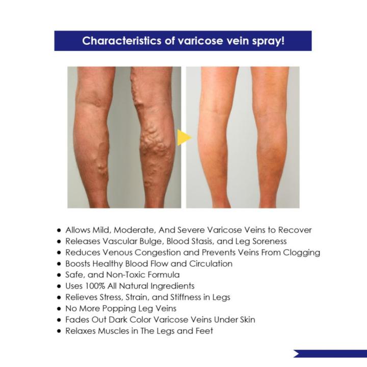 %E3%80%90Top-Rated%20Product%E3%80%91%20Varicose%20Veins%20Spray%20Spider%20Veins%20Relief%20Vasculitis%20Phlebitis%20Spider%20Pain%20Relief%20Plaster%20Care%2030ml%20-%20Image%207