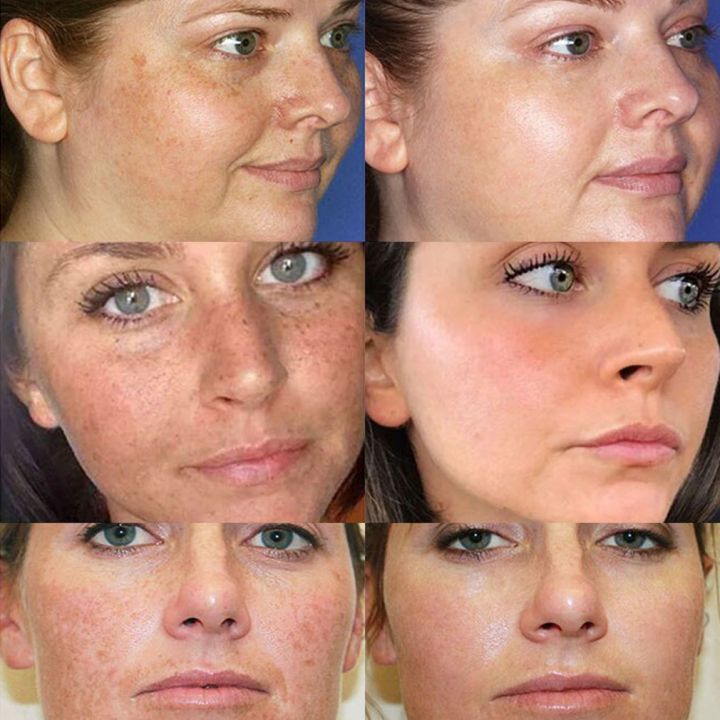 %E3%80%90The%20Edge%20of%20Beauty%E3%80%91Whitening%20freckle%20cream%20remove%20melasma%20melanin%20spots%20lightening%20cream%20-%20Image%207