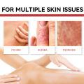 Psoriasis Treatment Cream Antibacterial Dermatitis Eczema Therapy Relieve Rash Urticaria Skin Herbal Skin Anti Itch Ointment 30g.