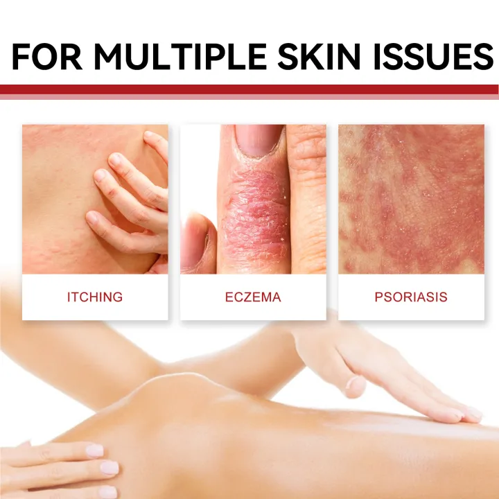 Psoriasis%20Treatment%20Cream%20Antibacterial%20Dermatitis%20Eczema%20Therapy%20Relieve%20Rash%20Urticaria%20Skin%20Herbal%20Skin%20Anti%20Itch%20Ointment%2030g%20-%20Image%203
