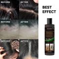 Treatment Of Psoriatic Seborrheic Dermatitis With Anti Tinea Capitis And Anti Itching Shampoo Anti Dandruff And Oil Control Hair. 