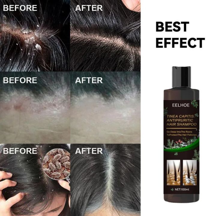Treatment%20Of%20Psoriatic%20Seborrheic%20Dermatitis%20With%20Anti%20Tinea%20Capitis%20And%20Anti%20Itching%20Shampoo%20Anti%20Dandruff%20And%20Oil%20Control%20Hair%20-%20Image%202