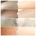 White Cream, Moisturizing Skin, Chicken Repair Cream, Buttocks, Back Acne, Body Acne Cream, Facial Sores, Smooth Marks.