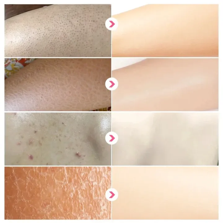 White%20Cream,%20Moisturizing%20Skin,%20Chicken%20Repair%20Cream,%20Buttocks,%20Back%20Acne,%20Body%20Acne%20Cream,%20Facial%20Sores,%20Smooth%20Marks%20-%20Image%204