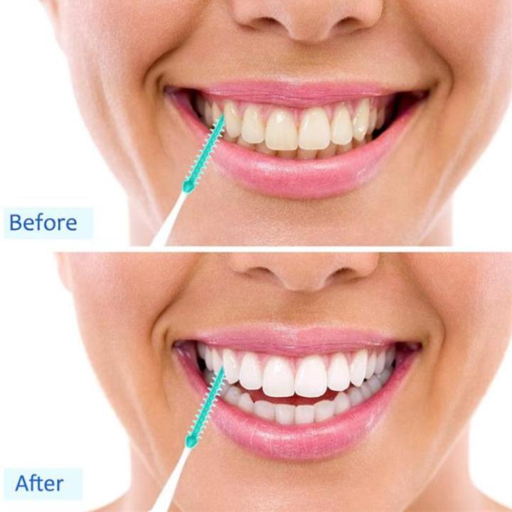 100pcs%20/Set%20Silicone%20Interdental%20Brushes%20Super%20Soft%20Dental%20Cleaning%20Brush%20Teeth%20-%20Image%204