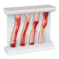 LDL Cholesterol Blood Vessel Model, 4-Stage Vascular Disease Teaching and Training Tool. 