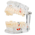 Pathology Model With Missing Tooth Tooth-tooth For Dental Experimental. 