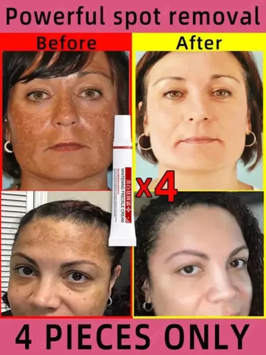 Face%20Chloasma%20Removal%20Cream%20For%20Women%20Remove%20Melasma%20Brighten%20Cream%20Facial%20Fade%20Dull%20Brightening%20Cream%20Dark%20Skin%20Lightening%20Care%20-%20Image%203