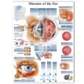 WANGART Poster Diseases of the Eye Chart Posters Refractiv Canvas print Wall Pictures for Medical Education Home Decor. 
