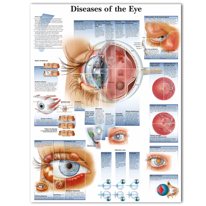 WANGART Poster Diseases of the Eye Chart Posters Refractiv Canvas print Wall Pictures for Medical Education Home Decor