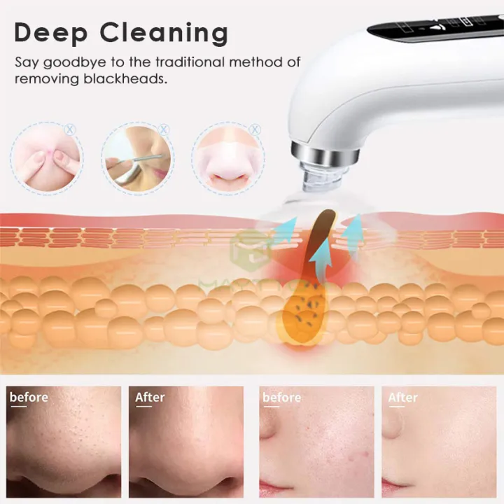 MAYTTO%20Electric%20Bubble%20Blackhead%20Remover%20Small%20Vacuum%20Suction%20Acne%20Extractor%20Pores%20Deeply%20Cleaning%20USB%20Rechargeable%20Water%20Cycle%20Pore%20Acne%20Pimple%20Removal%20Facial%20Cleaning%20Tool%20with%206%20Tips%20-%20Image%204