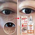 Fat Granules Removal Eye Serum Eye Milia Repair Treatment Products Wrinkle Lifting Moisturizing Anti-Puffiness Korean Skin Care.