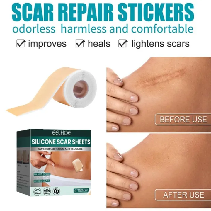 1%20Roll%20Surgery%20Scar%20Removal%20Silicone%20Gel%20Sheet%20Patch%20Tape%20Sticker%20Skin%20Repair%20-%20Image%203