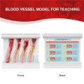 LDL Cholesterol Blood Vessel Model, 4-Stage Vascular Disease Teaching and Training Tool. 