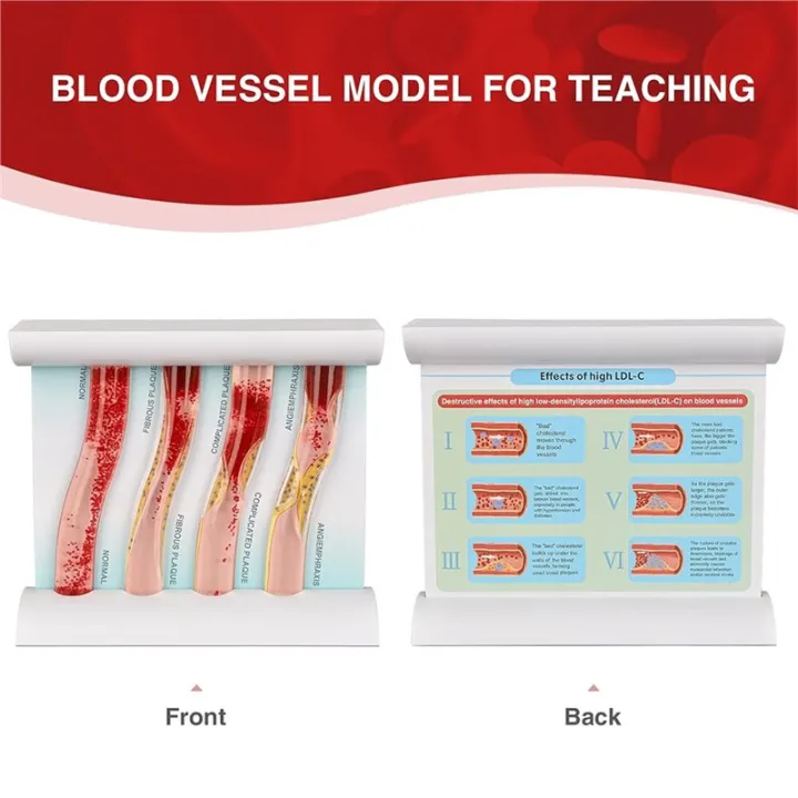 LDL%20Cholesterol%20Blood%20Vessel%20Model,%204-Stage%20Vascular%20Disease%20Teaching%20and%20Training%20Tool%20-%20Image%208