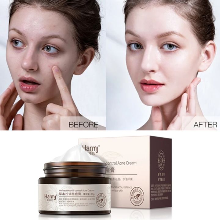 Remove%20Melasma%20Azelaic%20Acid%2020%25%20Whitening%20Fades%20Acne%20Cream%20Freckle%20Dark%20Pigment%20Spots%20Melanin%20Alpha%20Arbutin%20Face%20Cream%20Skin%20Care%20-%20Image%203