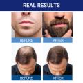 Kirkland Signature Minoxidil 5% Topical Solution Extra Strength Beard & Hair Regrowth Treatment 60ml 1 Month Supply - 100% Original - MNXMS. 