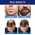 Kirkland Signature Topical Minoxidil 5% Extra Strength for Men Hair Regrowth Treatment - MNXMS.