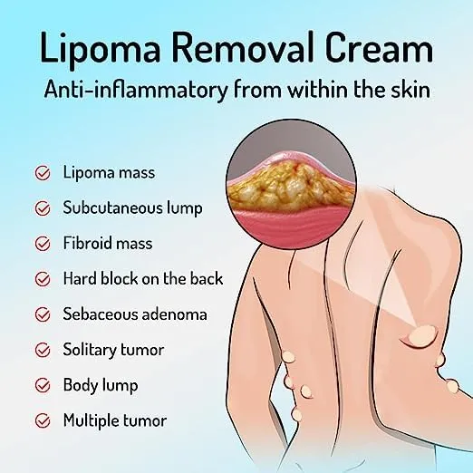HERBAL%20LIPOMA%20REMOVAL%20CREAM%20MILD%20EASY%20TO%20USE%20CARE%20CREAM%20WIDE%20APPLAICATIONS%20%7C%20MILD%20&%20COMFORTABLE%20%7C%20HERBAL%20-%20Image%206