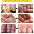 New Nail Repair Eence Fungal Removal Gel Anti Infection Paronychia Onychomycoi 10ml. 