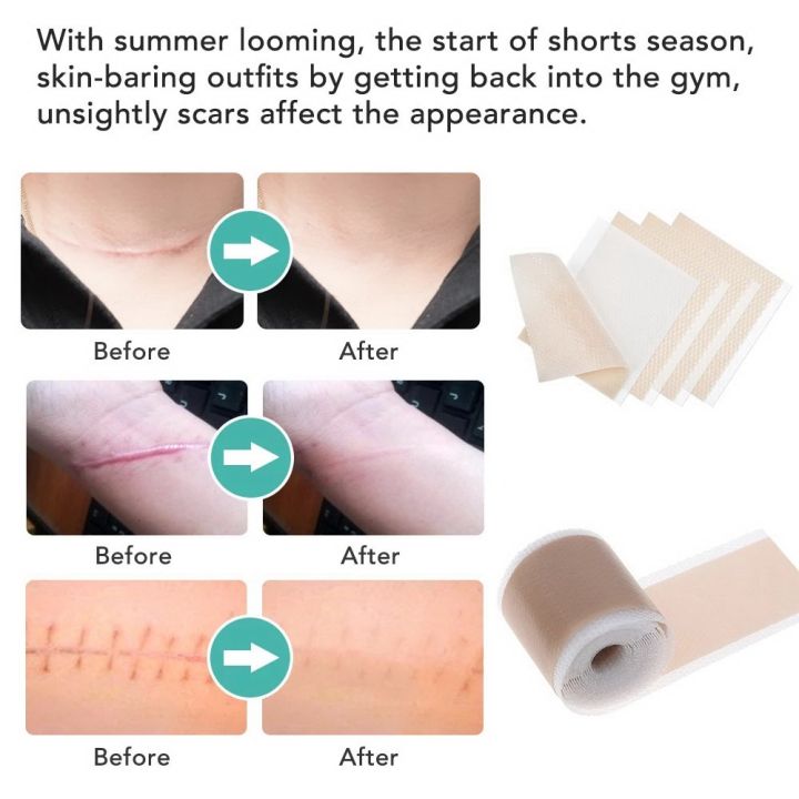 3PC%20Efficient%20Surgery%20Scar%20Removal%20Silicone%20Gel%20Sheet%20Therapy%20Patch%20for%20Acne%20Trauma%20Burn%20Scar%20Skin%20Repair%20Scar%20Treatment%20-%20Image%206