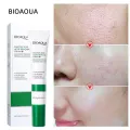 BIOAQUA Acne Removal Cream Anti Acne Treatment Repair Marks Moisturizing Blackhead Remover Facial Cream Skin Care-20gm.
