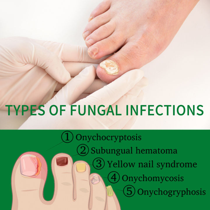 Jaysuing%20Ginger%20Nail%20Treatment%20Moisturizer%20for%20soft%20nails,%20nail%20brightening,%20nail%20fungus,%20nail%20repair,%20hand%20and%20foot%20nails%20-%20Image%203