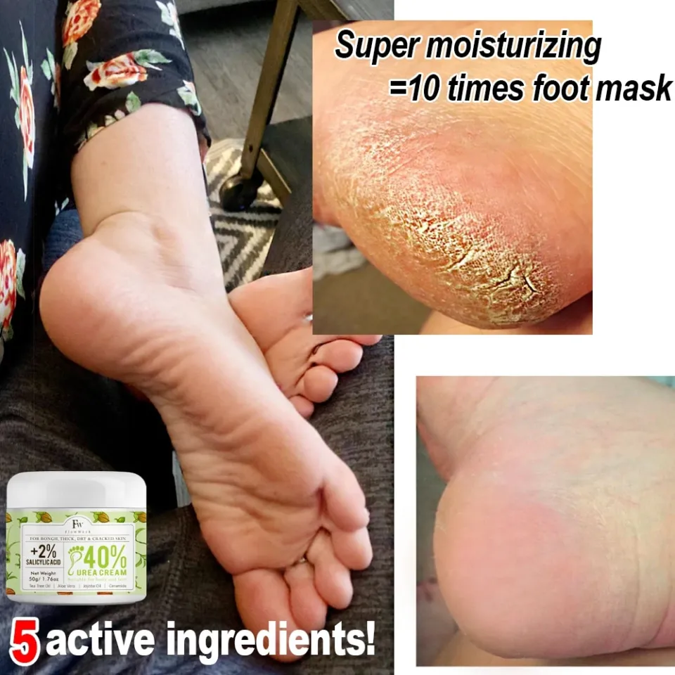 Chronic Cracked Skin On Soles Of Feet Extremely Dry Skin May Lead