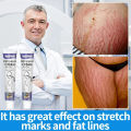 Stretch Marks Permanent Removal Cream Eliminate Body Belly Stretch Marks Swelling Marks Remove Skin Cracks. 
