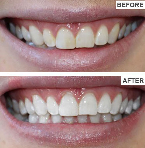 ELHOE%20Teeth%20Whitening%20Drops%20%E2%80%93%20100%25%20Natural%20Herbal%20Formula%20%E2%80%93%20Instantly%20Whitens%20Yellow%20Teeth,%20Removes%20Stains,%20Fights%20Bad%20Breath%20&%20Plaque%20%E2%80%93%20Strengthens%20Gums%20&%20Enamel%20%E2%80%93%20Safe%20for%20Sensitive%20Teeth%20%E2%80%93%20Fluoride-Free%20Liquid%20Oral%20Care%20for%20Men%20&%20Women%20-%20Image%207
