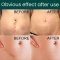 1 Roll Surgery Scar Removal Silicone Gel Sheet Patch Tape Sticker Skin Repair.