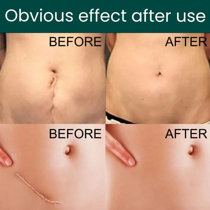 1%20Roll%20Surgery%20Scar%20Removal%20Silicone%20Gel%20Sheet%20Patch%20Tape%20Sticker%20Skin%20Repair%20-%20Image%204
