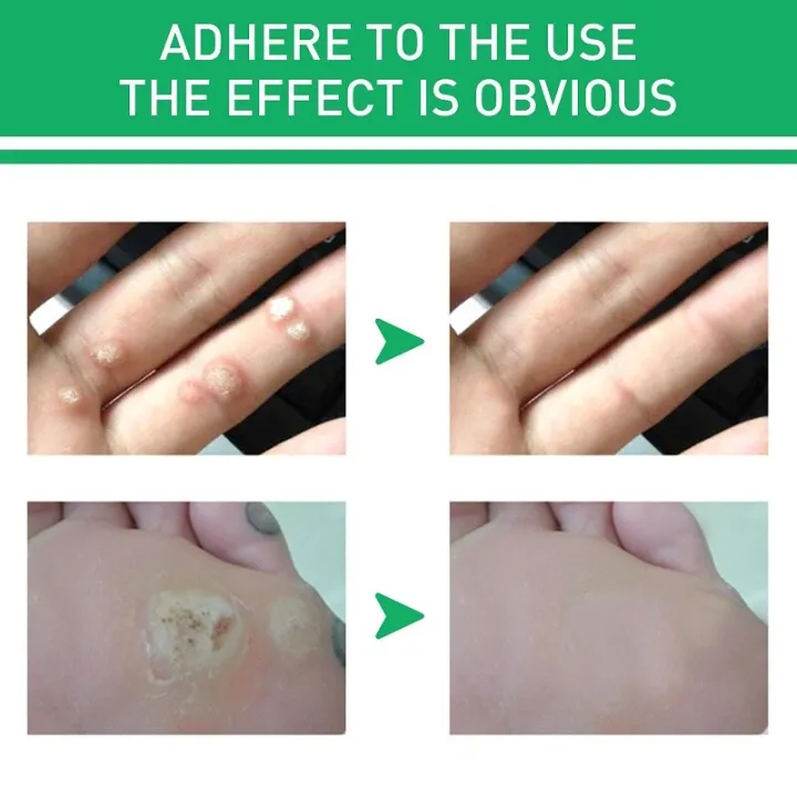 Effective%20Foot%20Corn%20Remover%20Care%20Remove%20Foot%20Calluses%20Remove%20Warts%20Smooth%20Skin%20Mild%20Wart%20Remover%20Corns%20Foot%20Care%20Liquid%20Solution%20-%20Image%204