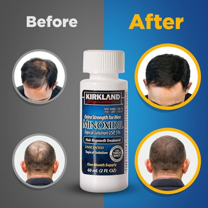 Kirkland%20Minoxidil%205%25%20for%20Beard%20&%20Hair%20Growth%20-%20Image%205
