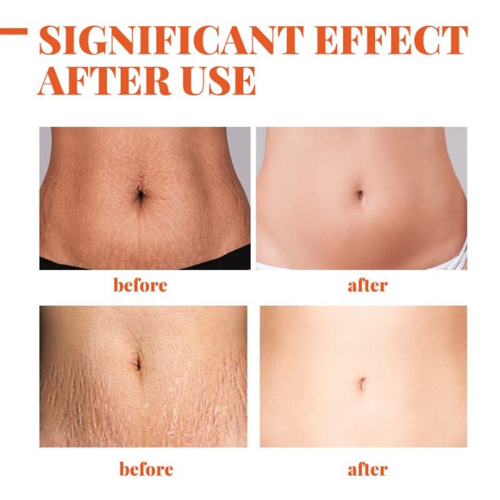 %E3%80%907Rings%20Store%E3%80%91Repair%20Essential%20Oil%20Stretch%20Mark%20Removal%20Removal%20Acne%20Stretch%20Marks%20Fat%20Striae%20Gravidarum%20Oils%2020ml%20-%20Image%203