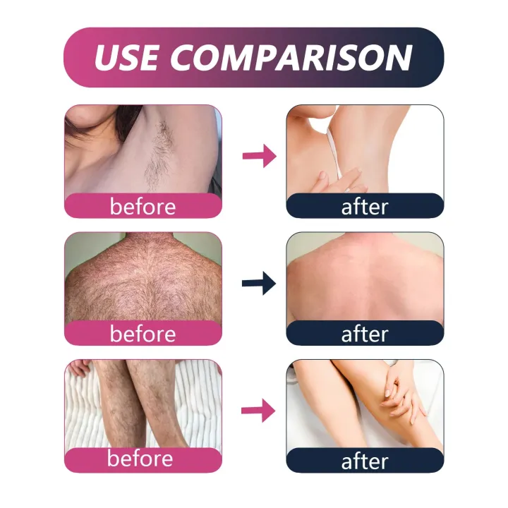 EELHOE%20Hair%20Removal%20Cream%20Series%20Painless%20Hair%20Remover%20Mild%20Non%20Irritating%20Permanent%20Hair%20Removal%20for%20Men%20Women%20Depilatory%20Cream%20-%20Image%206